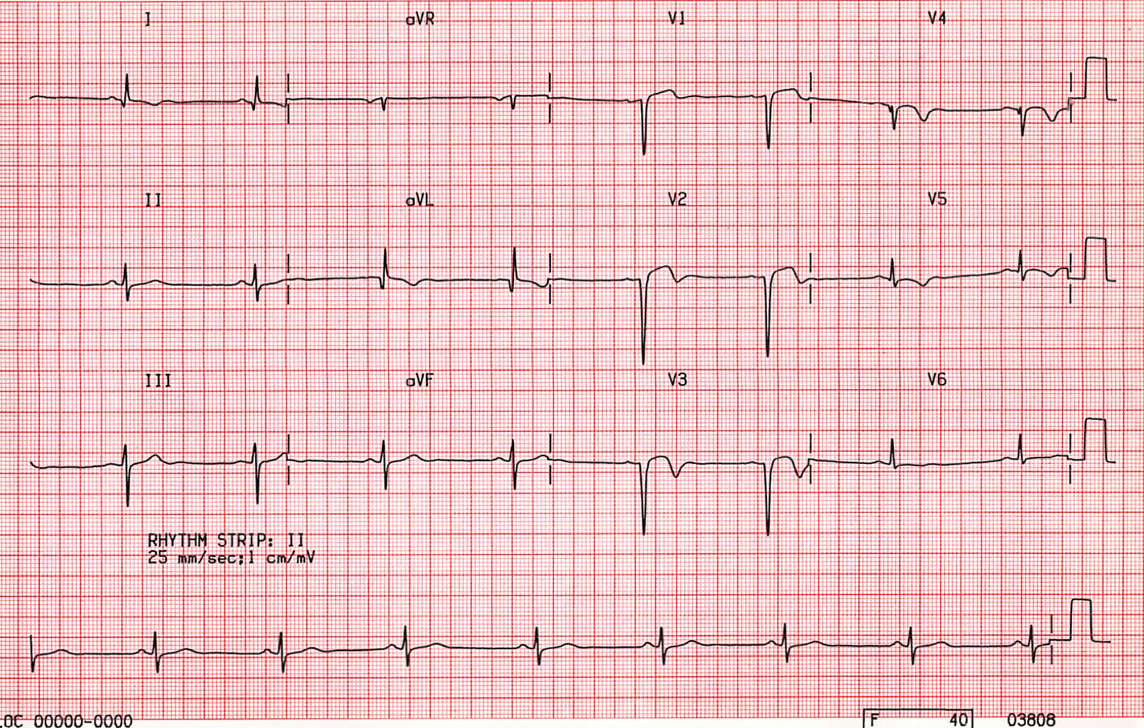 Case B1 Sinus Bradycardia With Old Anterior Myocardial Infarction • St