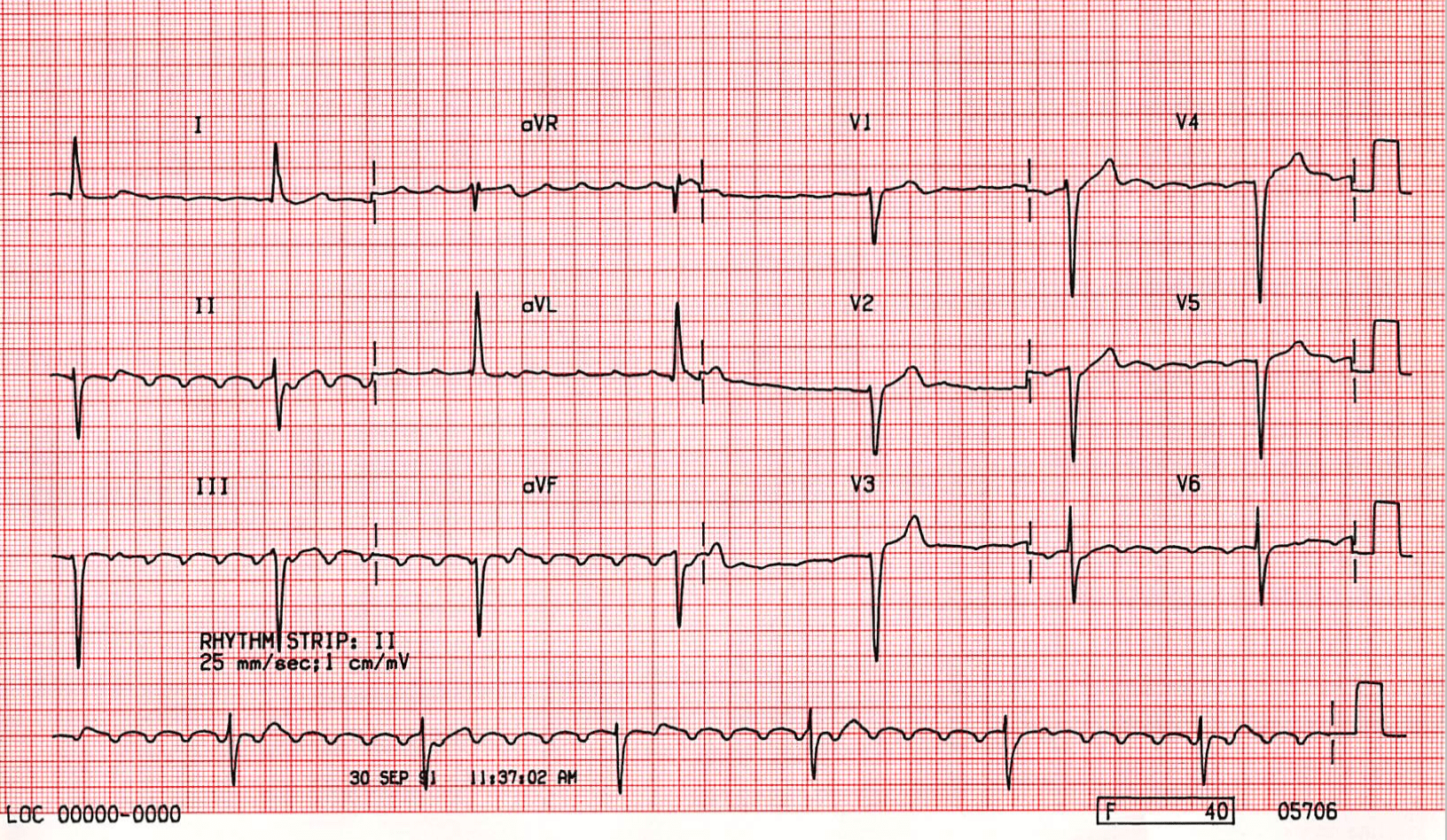 Case b10 complete heart block and atrial flutter st emlyn s ecg library 