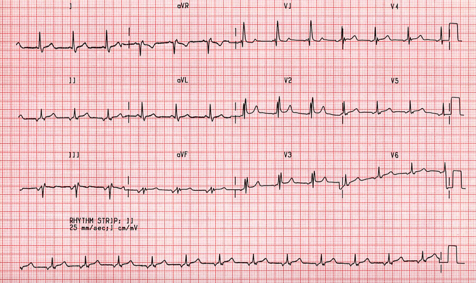 case b12 junctional rhythmn with right bundle branch block rbbb ecg