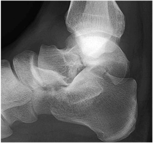 Fracture of the Talus