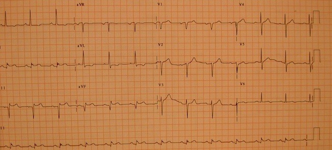 EKG in inferior myocardial infarction