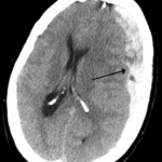 SUBDURAL WIKIPEDIA