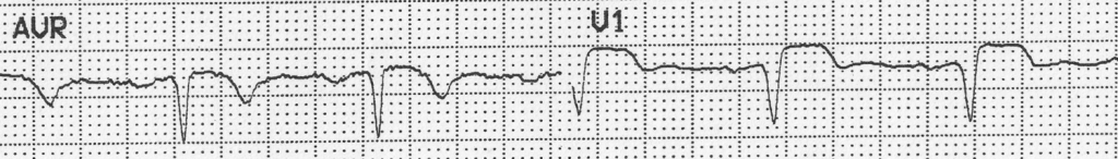 Unusual ECG 2