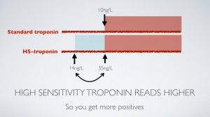 High sensitivity troponin T reads higher than the standard troponin T assay