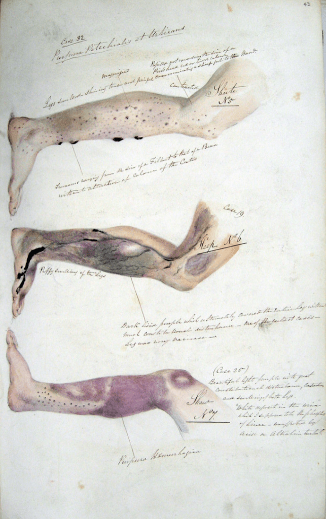 Page from the journal of Henry Walsh Mahon showing the effects of scurvy, from his time aboard HM Convict Ship Barrosa. 1841/2 via Wikipedia