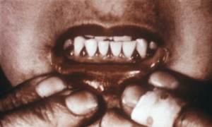 Scorbotic gums via Wikipedia