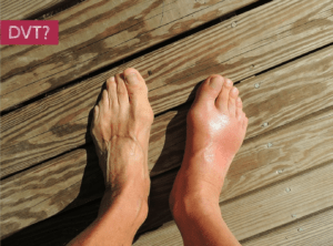 Is it a DVT?