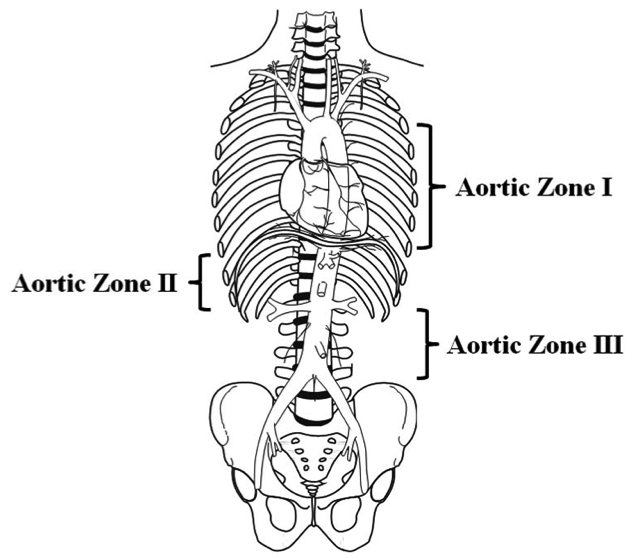 aortic-zones