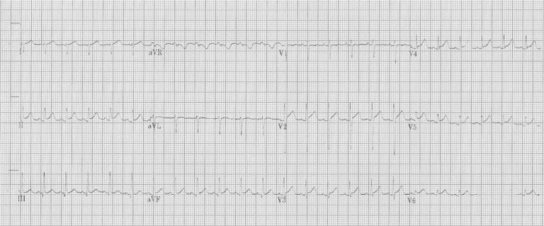 ECG in myocarditis