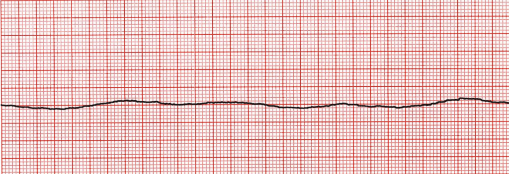 ECG: Cardiac Asystole