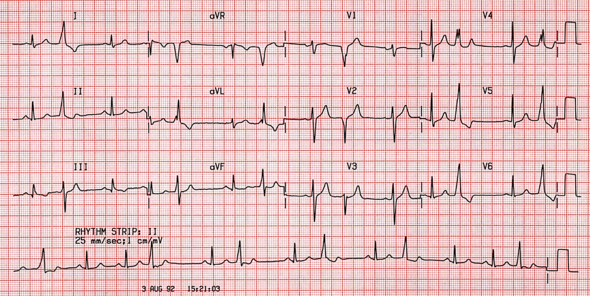 Case B21. Ventricular Premature Beats • ECGs at St Emlyn's