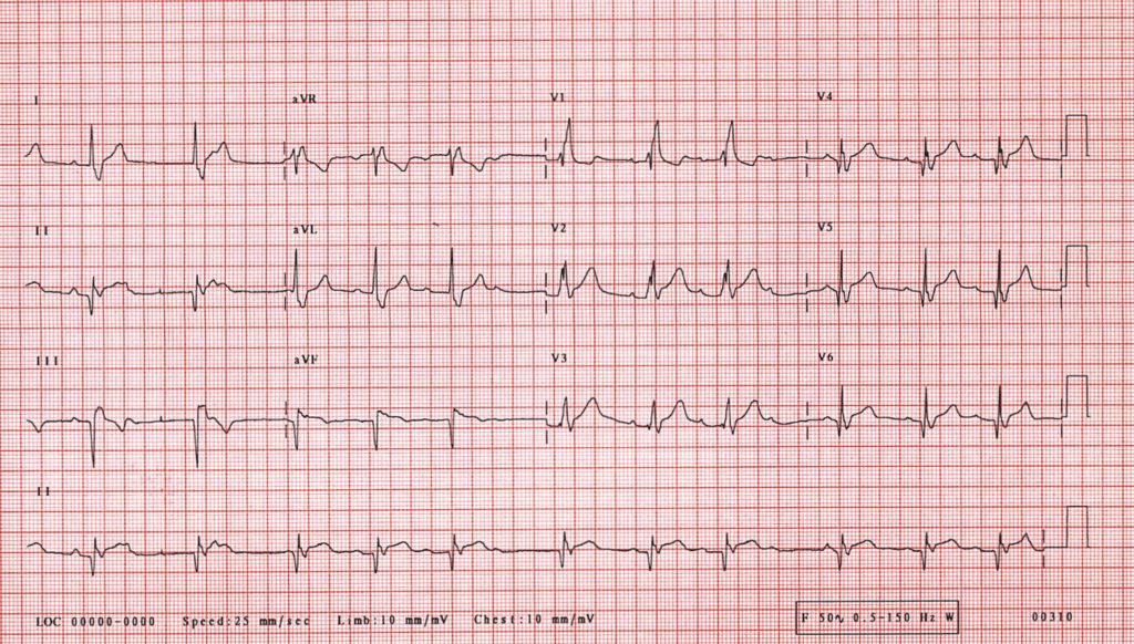 B24 Right Bundle Branch Block With The Wenckebach Phenomenon In Acute Myocardial Infarction St Emlyn S
