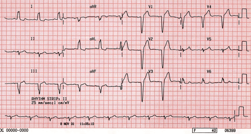 ECG Left Bundle Branch Block