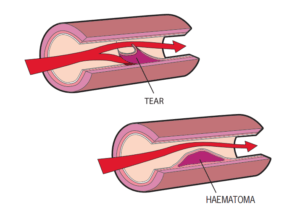 A tear the endothelia and intimal layers