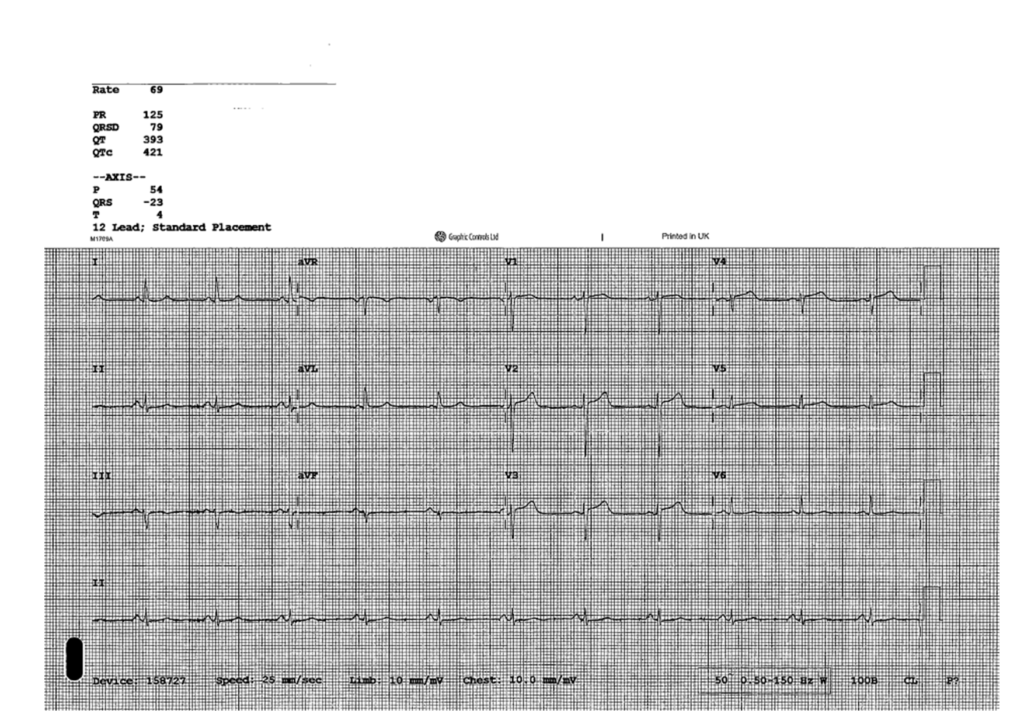 An ECG of a patient with SCAD