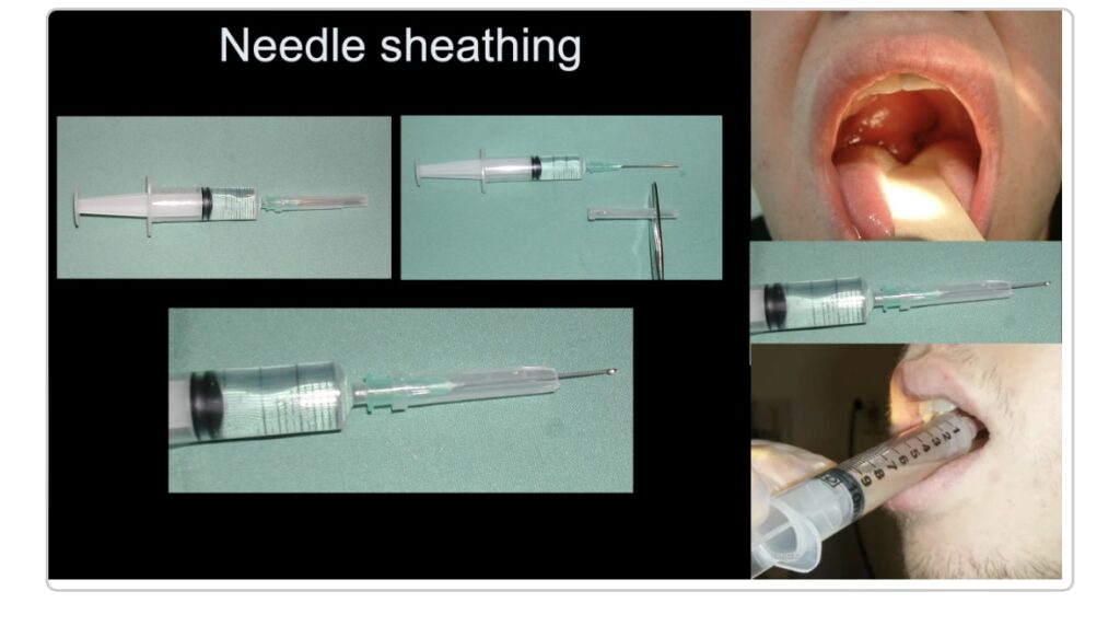 Needle sheathing