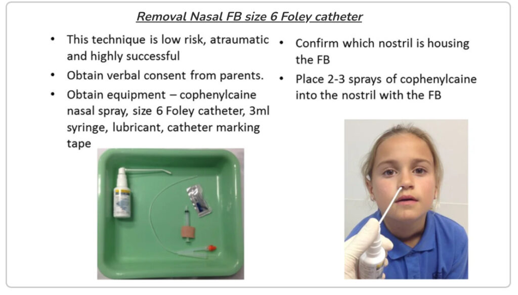 Removing a nasal foreign body