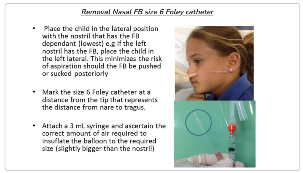 Removing a nasal foreign body
Removal Nasal FB size 6 Foley catheter
•
·
Place the child in the lateral position
with the nostril that has the FB dependant (lowest) e.g if the left nostril has the FB, place the child in the left lateral. This minimizes the risk of aspiration should the FB be pushed or sucked posteriorly
Mark the size 6 Foley catheter at a distance from the tip that represents the distance from nare to tragus.
• Attach a 3 mL syringe and ascertain the correct amount of air required to insuflate the balloon to the required size (slightly bigger than the nostril)