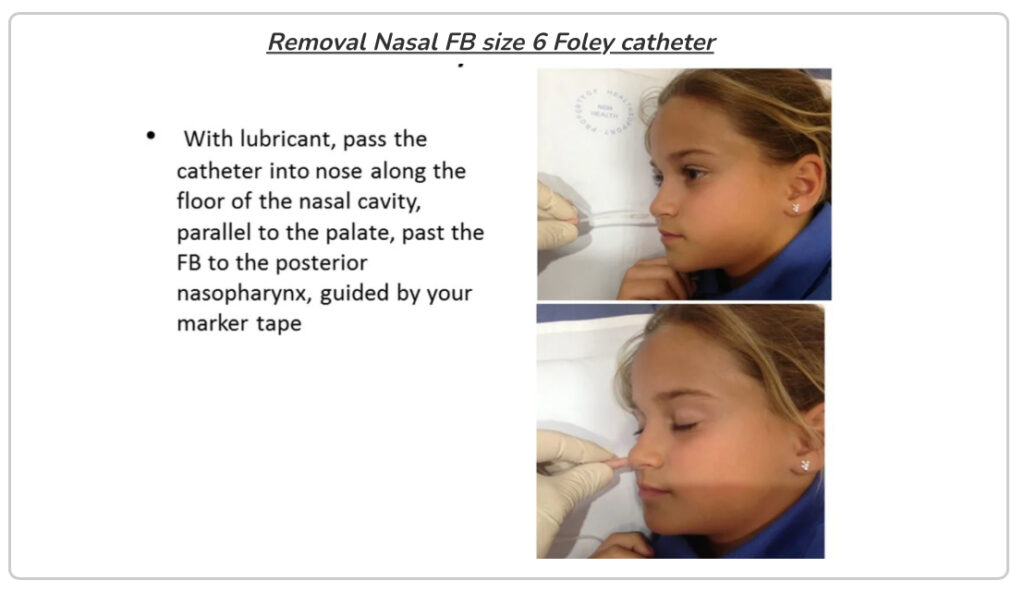 Removal Nasal FB size 6 Foley catheter
With lubricant, pass the
catheter into nose along the floor of the nasal cavity, parallel to the palate, past the FB to the posterior nasopharynx, guided by your marker tape