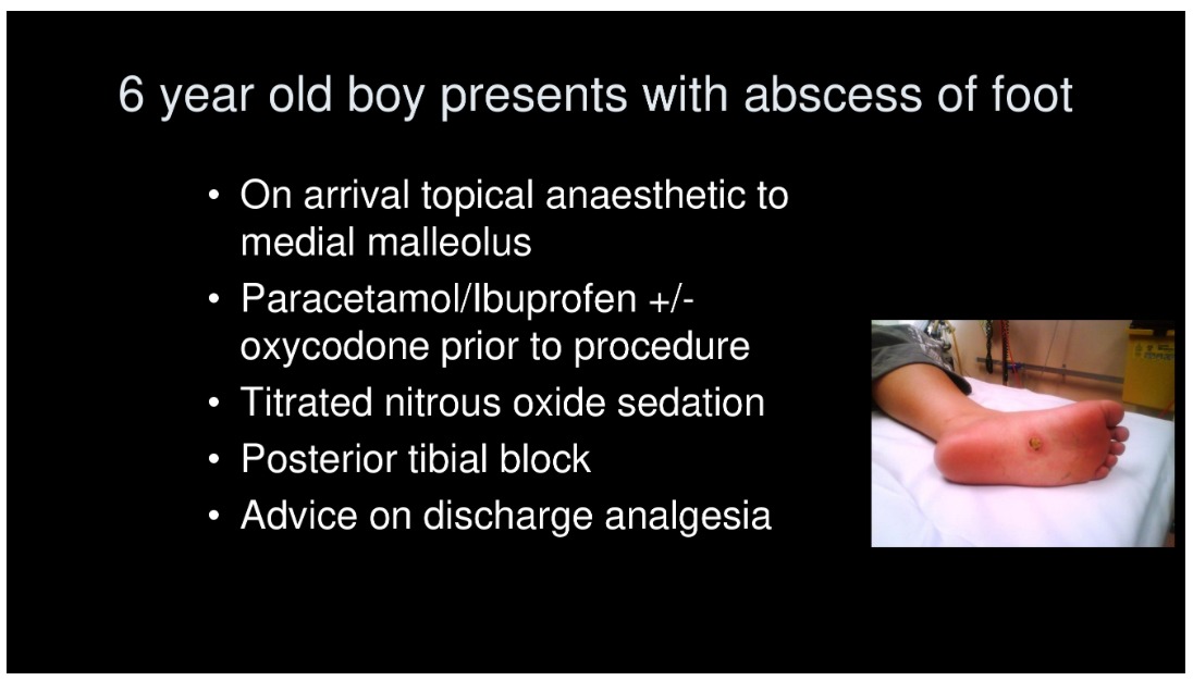 6 year old boy presents with abscess of foot
On arrival topical anaesthetic to medial malleolus
• Paracetamol/lbuprofen +/- oxycodone prior to procedure Titrated nitrous oxide sedation
• Posterior tibial block
•
Advice on discharge analgesia